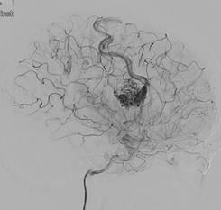 画像　AVM塞栓術後