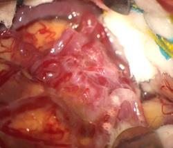 画像　開頭にてAVMを露出