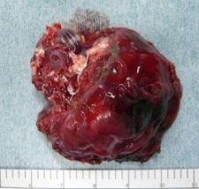 画像　摘出されたAVM